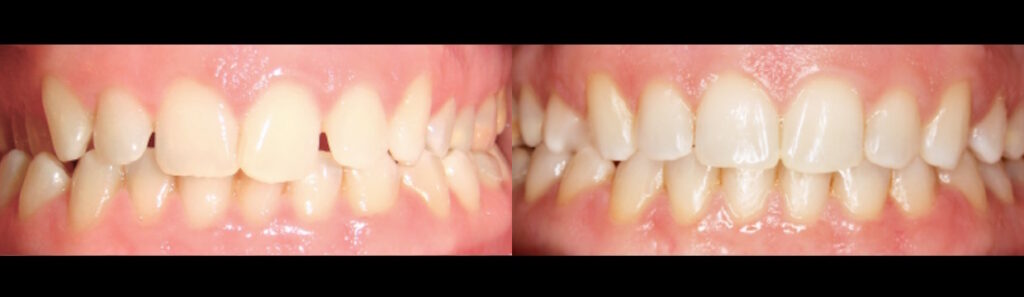Before and after: Ceramic Braces