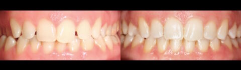 Ceramic Braces