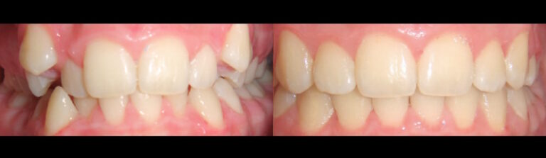 Before and after: Ceramic Braces