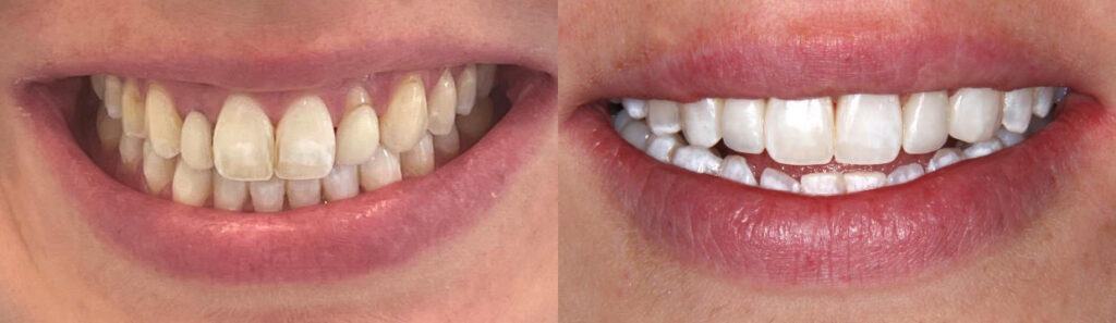 Before and after: Maryland Bridge