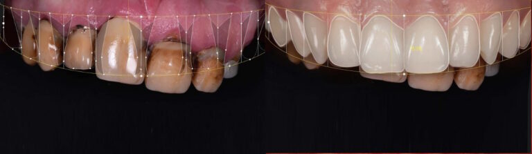 Before and after: Navigated Implants