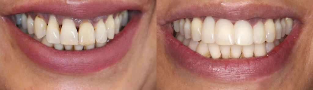 Before and after: Periodontal treatment and composite fillings