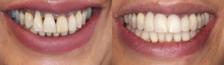 Before and after: Periodontal treatment and composite fillings