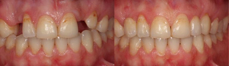 Before and after: Replacing missing front teeth with Maryland bridges