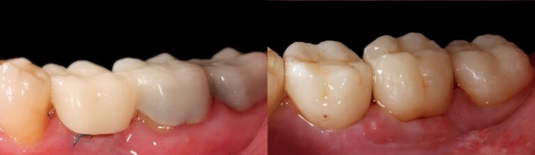 Before and after: Single-tooth immediate implant