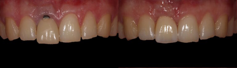 Before and after: Single implants replacing front teeth