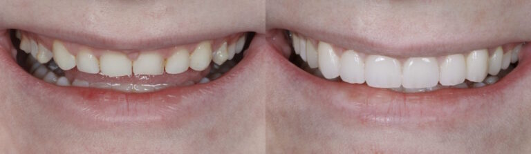 Before and after: Porcelain Veneers