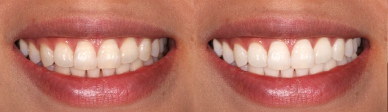 Before and after: Teeth Whitening