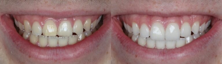 Before and after: Teeth whitening & Composite bonding