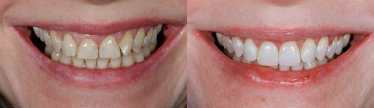 Before and after: Teeth whitening & Invisalign & Composite bonding