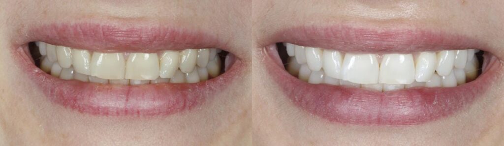 Before and after: Teeth Whitening