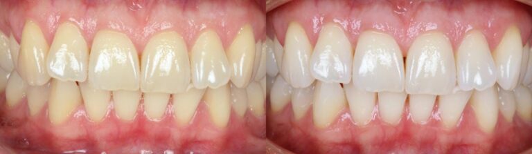 Before and after: Teeth Whitening