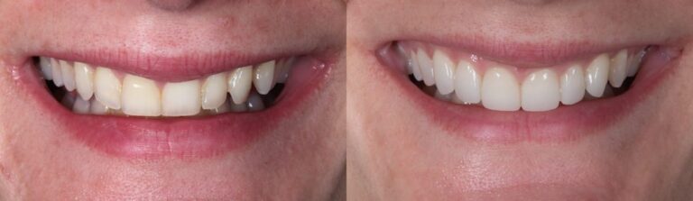 Before and after: Veneers