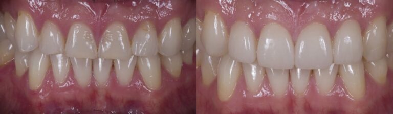 Before and after: Veneers