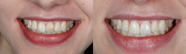 Before and after: Veneers