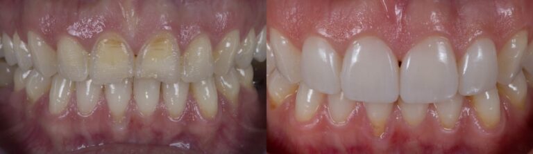 Before and after: Veneers