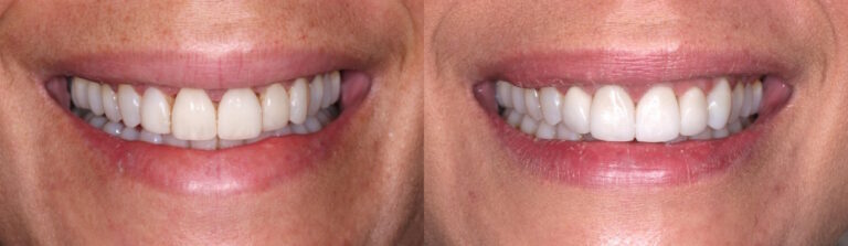 Before and after: Veneers