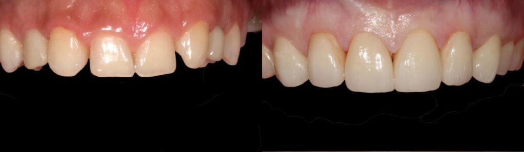 Before and after: Veneers