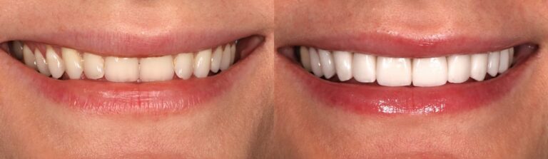 Before and after: Porcelain veneers