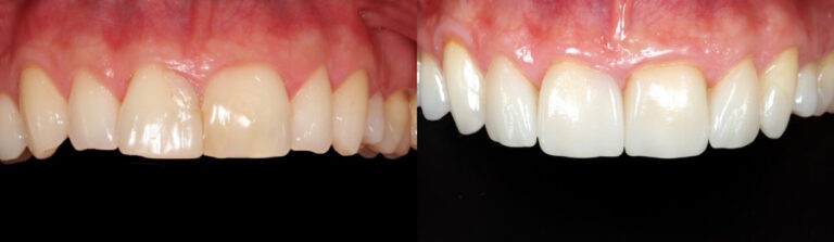 Before and after: Veneers