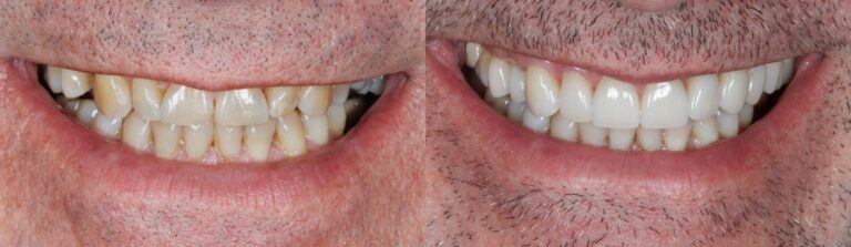 Before and after: Veneers
