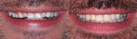 Restoration of the entire dentition