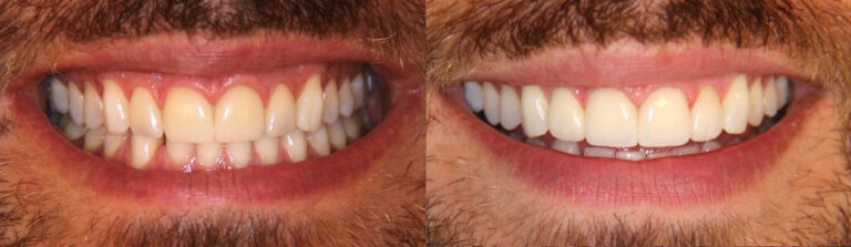 Before and after: Veneers