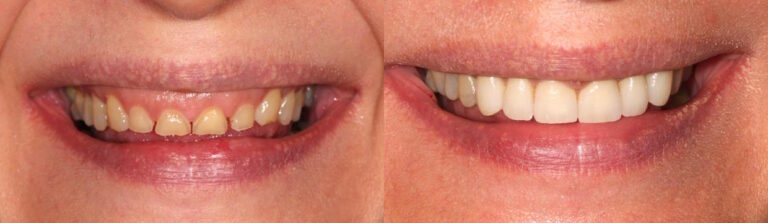 Before and after: Veneers upper jaw and bone correction