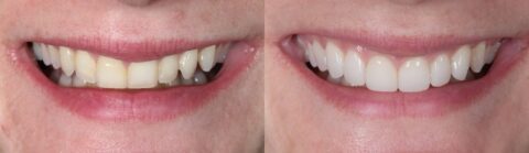 Porcelain veneers