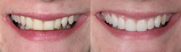 Before and after: Porcelain veneers