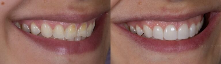 Before and after: Veneers