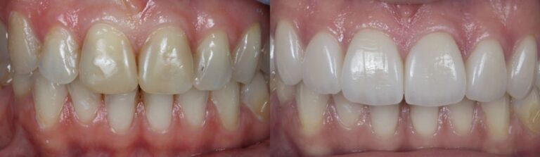Before and after: Veneers
