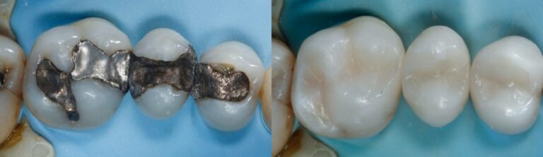 Before and after: Keeping a tooth alive with vital pulp therapy
