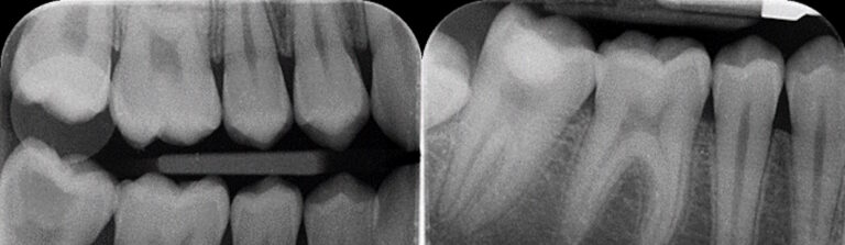 Before and after: Vital Pulp Therapy
