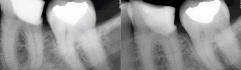 Before and after: Vital Pulp Therapy