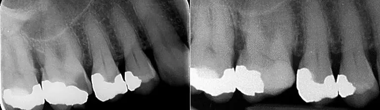Before and after: Vital Pulp Therapy