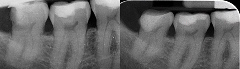 Before and after: Vital Pulp Therapy