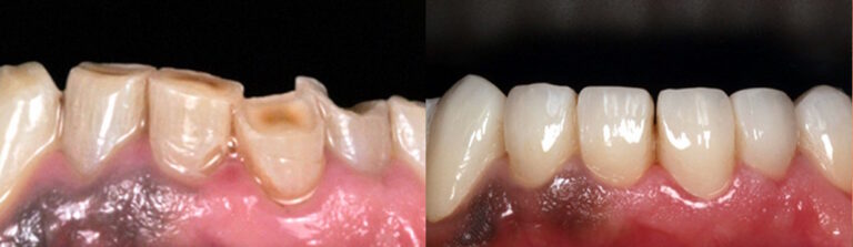 Before and after: Worn out teeth repair with Ceramic Crowns