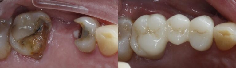 Before and after: 3 unit zirconia bridge