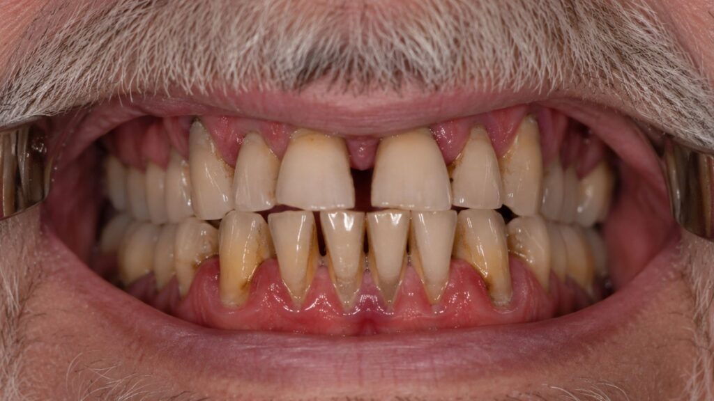 Diabetes And Periodontitis.jpg
